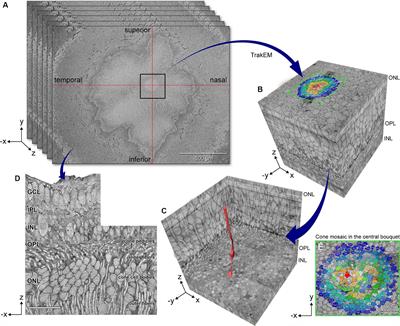 Unusual morphology of foveal Müller glia in an adult human born pre-term